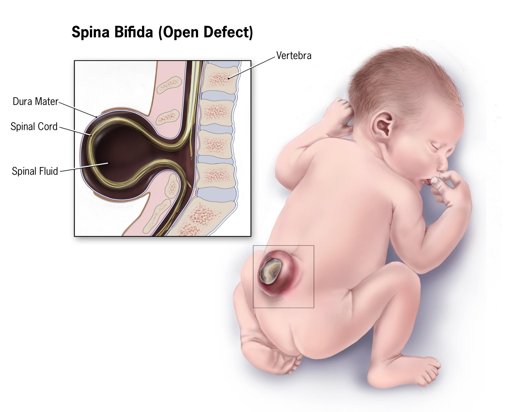 How can pregnancy tests determine risks for Neural tube defects?